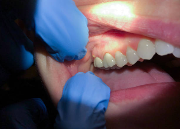 Best Emergency Treatment for Dental Infections or Abscesses in Faith, NC